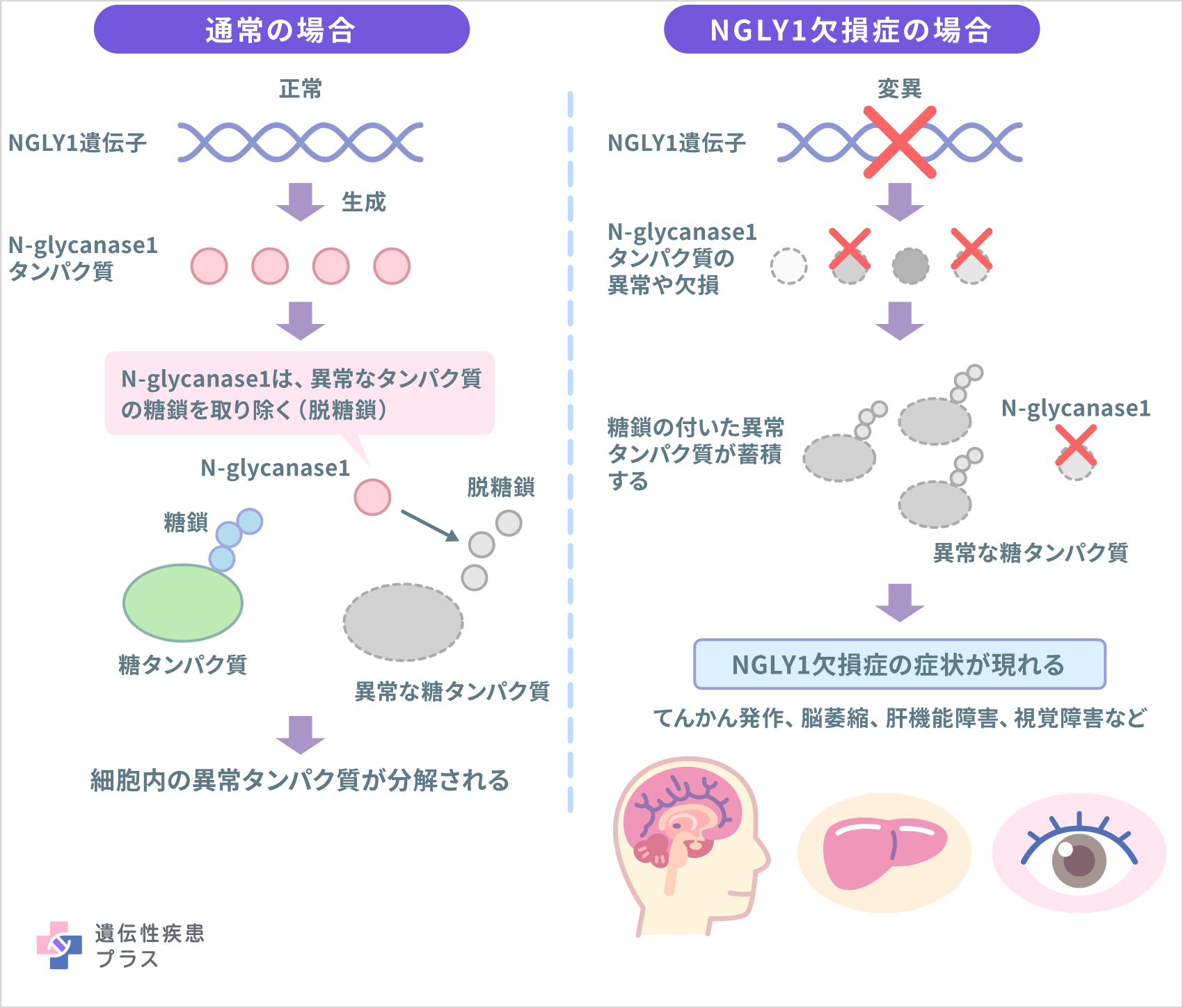 152 Ngly1欠損症 240919