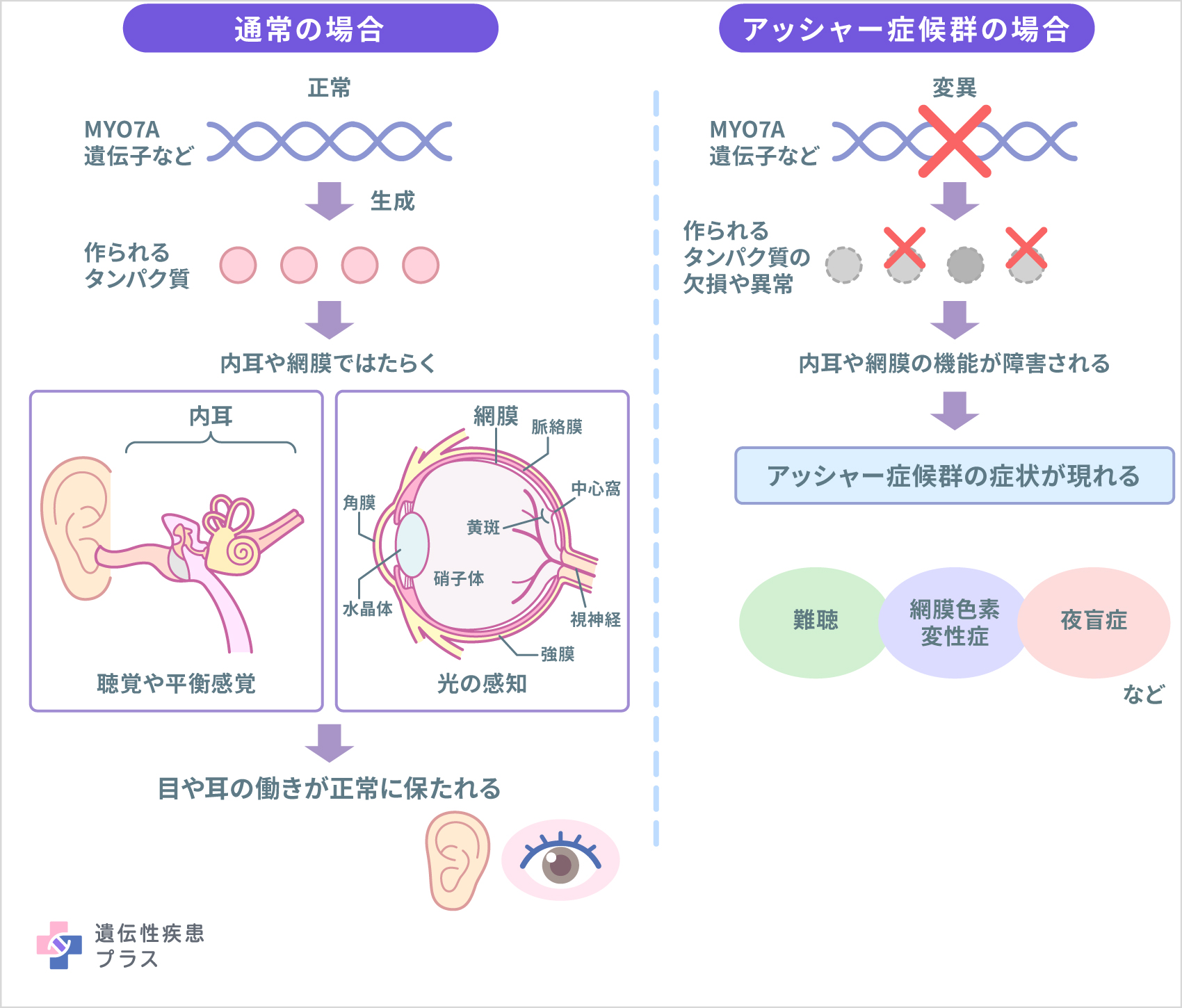 157 アッシャー症候群 仕組み